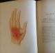 Atlas Of Skin Diseases 1st Edition 1877 Tilbury Fox Dermatology Medical Other photo 9