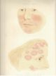 Atlas Of Skin Diseases 1st Edition 1877 Tilbury Fox Dermatology Medical Other photo 1