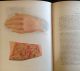 Atlas Of Skin Diseases 1st Edition 1877 Tilbury Fox Dermatology Medical Other photo 2
