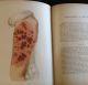 Atlas Of Skin Diseases 1st Edition 1877 Tilbury Fox Dermatology Medical Other photo 4