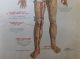 1912 Wagner Litho Print Medical Art - Accidents & Stopping Bleeding Quack Medicine photo 7
